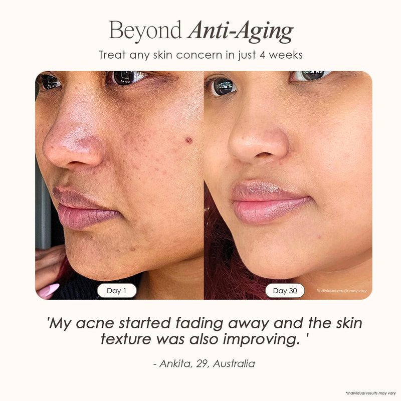 Nuvio High Frequency Acne Wand