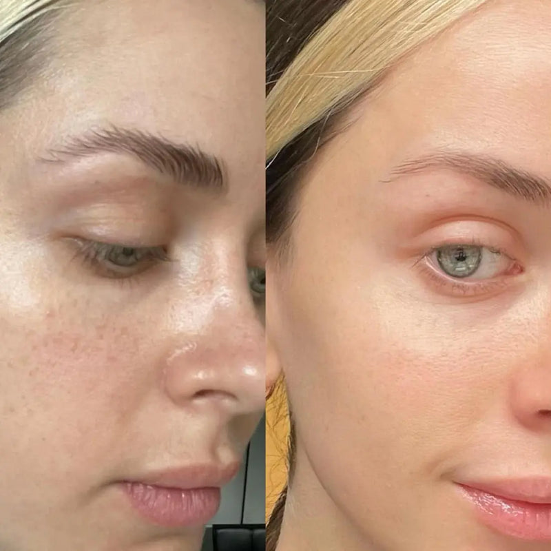 Nuvio Vegan Micro-Infusion Treatment